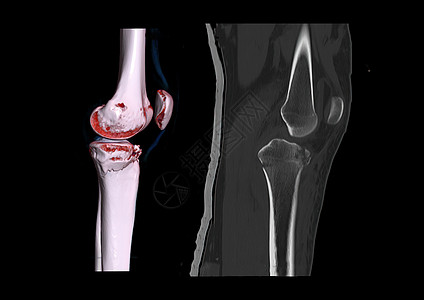 比较 CT 膝关节 3D 渲染图像横向视图和 CT 膝关节 2D 矢状视图隔离在黑色背景上 显示胫骨骨折图片