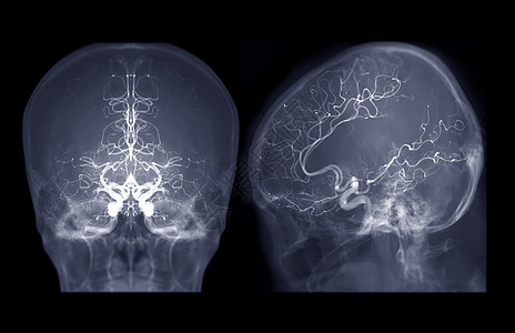 脑血管成像AP和通过干预放射学显示脑动脉的含氟透镜中的横向视觉图像系统扫描医院放射科动脉血液循环外科病人诊断解剖学图片