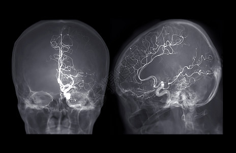 脑血管成像AP和通过干预放射学显示脑动脉的含氟透镜中的横向视觉图像解剖学中风放射科血管小动脉药品诊断动脉大脑病人图片