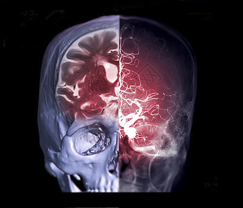 CT MRI 大脑和脑血管造影图像前视图的融合图像显示大脑和大脑动脉的解剖图片