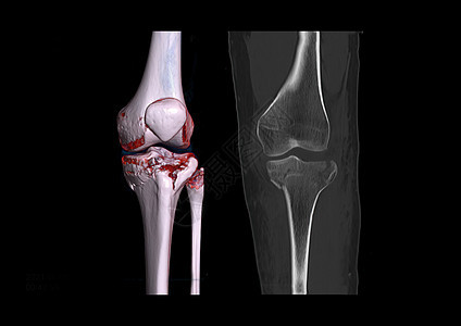 比较 CT 膝关节 3D 渲染图像和在黑色背景上隔离的 CT 膝关节 2D 冠状视图 显示胫骨骨折图片