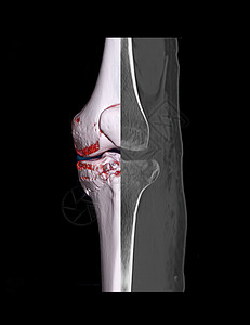 对比CT膝盖关节3D成像图象和CCT膝盖2D在黑色背景下被隔离 显示有骨折的四肢骨骼骨折扫描器骨科科学插图股骨膝伤教育技术软骨腓图片
