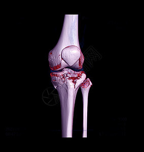 CT膝盖3D立体成像显示四肢骨折断层症状事故射线临床运动医院末端髌骨创伤图片