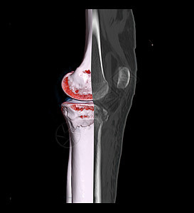 对比CT膝盖关节3D成像图象和CCT膝盖2D在黑色背景下被隔离 显示有骨折的四肢骨骼骨折临床末端扫描科学腓骨症状骨科事故扫描器身图片