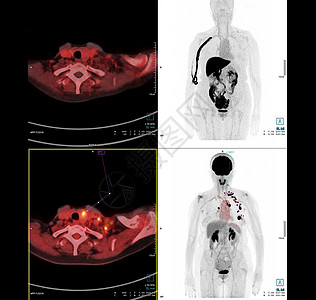 PET 胸部或胸腔扫描图象比较轴心 用于检查手术后肺癌复发的冠状腺镜像医疗技术概念宠物科学断层辐射药品病人放疗结核放射性疾病图片