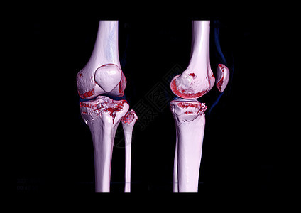 比较AP和CT膝盖的横向视图 3D 图像显示骨折四肢骨折图片