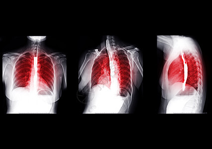 Esophagram的收藏品手术学习胃肠道食管病变气体外科钡餐诊断疾病图片