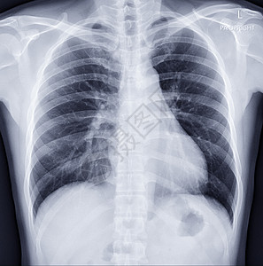 ct室用于诊断结核病 肺结核和 Covid-19的胸前X光图像背景
