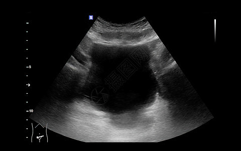用于检查肾脏和膀胱疾病的尿囊或库布的超声波腹痛调查医疗皮层考试病人药品输尿管脓肿治疗图片