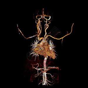 CTA胸动脉包括常见的颈动脉3D成像显示心血管系统射线颈动脉3d扫描仪医院动脉瘤诊断血管疾病渲染图片