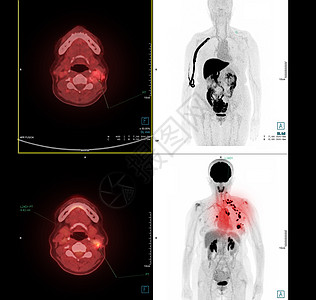 PET 颈部扫描图像 用于检测手术后肺癌复发 医疗技术概念图片