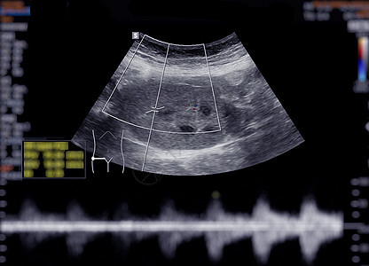 上腹部超声波显示肾脏小腹卵巢解剖学黄疸病人脓肿考试积液超声疾病图片