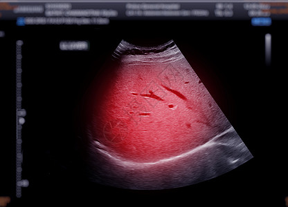 上腹部超声波显示肝脏超声脓肿回声药品检查胰腺小腹腹痛异质扫描图片