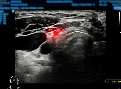 用于甲状腺诊断的甲状腺超声波光谱学症状检查激素医院脖子甲状腺炎扫描器药品考试癌症图片