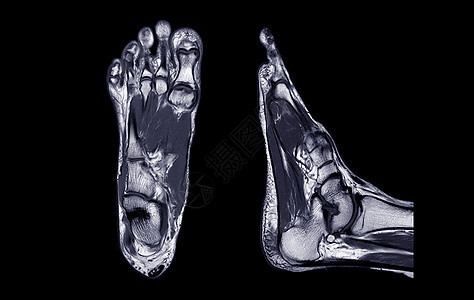 脚部或轴 科罗纳尔和人形外观的动脉共振成像 用于诊断趋势损伤腓骨骨骼解剖学电影治疗医师医院放射科骨科电脑图片