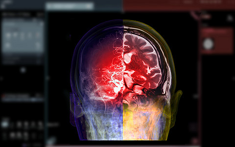 CTA脑和磁性脑聚变图像 医学技术概念图片