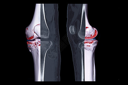 比较 CT 膝关节 3D 渲染图像与 CT 膝关节矢状视图和 CT 膝关节 2D 矢状视图隔离在黑色背景上 显示胫骨骨折图片