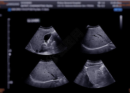 超声波上腹部显示胆囊 用于诊断胆囊石医院超声卵巢怀孕病人考试脓肿积液腹痛药品图片