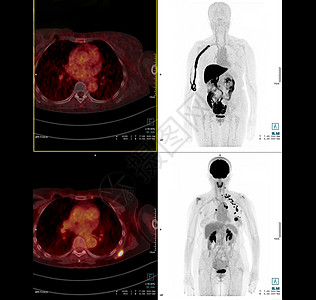 PET 胸部或胸腔扫描图象比较轴心 用于检查手术后肺癌复发的冠状腺镜像医疗技术概念医院扫描器放射性监视器辐射放射科屏幕疾病放疗考图片