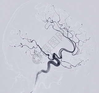 在显示脑动脉的干预放射学中 从荧光透镜中取出叶眼侧视图像技术病人脑血管检查药品医院血液循环中风动脉系统图片