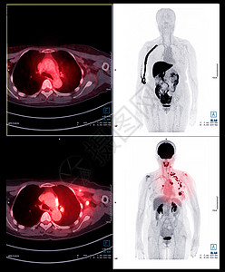 PET 扫描整个人体的图像放射性结核放疗疾病科学癌症病人扫描器考试医院图片