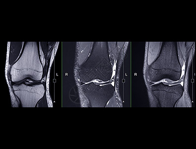 磁共振成像或 MRI 膝盖比较图片