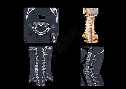 CT C-Spine或子宫颈脊椎轴视图 3D成形图像 Corona和侧面视图i图片