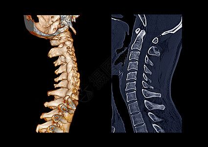 比较CT C脊椎或宫颈脊椎3D成像和人形图象螺丝骨科椎骨盘子骨骼诊断创伤技术痛苦疝气图片