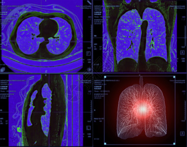 CT切斯特或肺3D选择性地聚焦于TB 肺结核和共生19的诊断监视器癌症心脏病学结核胸部屏幕胸椎监控呼吸系统科学放射科图片