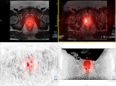 PET/MRI 前列腺图片