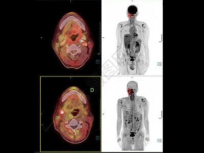 大脑内部结构PET CT Neck图象显示PET CT扫描仪的CA 鼻喉或鼻腔癌专家骨骼神经鼻咽部ct外科诊断学家病人速器背景