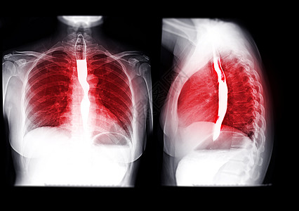 Esophagram的收藏品癌症胃肠道疾病支架化合物手术电影学习外科钡餐图片