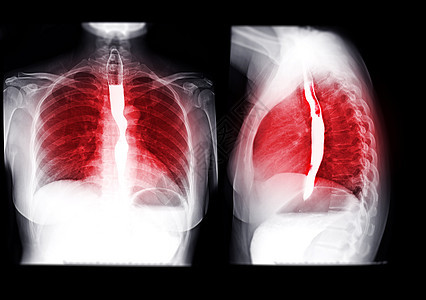 Esophagram的收藏品癌症胃肠道疾病支架化合物手术电影学习外科钡餐背景图片