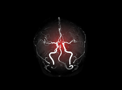 MRA 大脑或磁共振血管图象集图片