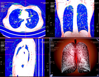 CT切斯特或肺3D选择性地聚焦于TB 肺结核和共生19的诊断监视器屏幕癌症监控科学呼吸系统辐射医生扫描药品医院图片