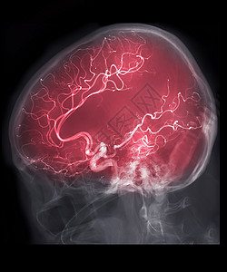 在干预放射学中 通过氟化镜检查获得的脑血管造影AP视觉图像手术药品血管荧光镜解剖学外科医院动脉诊断疾病图片