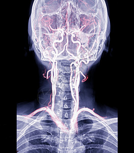 X射线 C-spine或X光图像 用于诊断脊椎间侧膜内分泌的宫颈脊椎AP视图和动脉图片