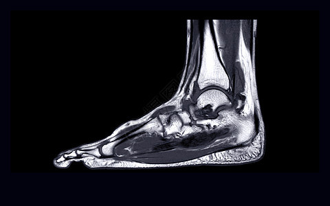 MRI FOOT 外观 T2 用于诊断导管损伤图片