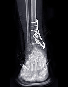 脚踝合体X光图像显示通过内置板和螺丝固定进行外科手术腓骨病人解剖学医生放射科胫骨腿痛伤害绷带疾病图片