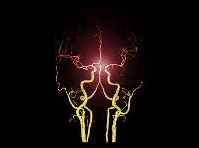 CTA BRIAIN 或CT脑3D成像图显示脑动脉谐振背景辐射放射科外科中风头痛3d大脑困惑图片