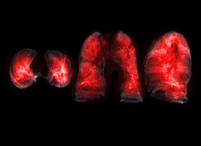 收集肺3D成像图像图片