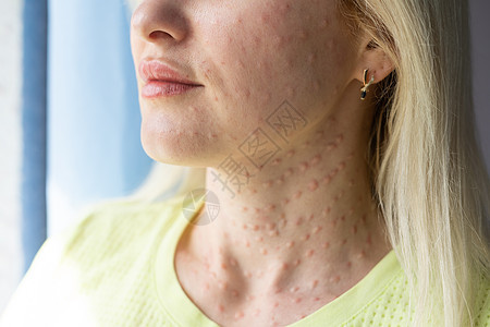 白色背景下的真实皮肤生物再生 女人脸上生物再生注射的痕迹 针痕透明质酸注射后美容治疗真丘疹特写程序中年病人皱纹药品皮肤科诊所老化图片