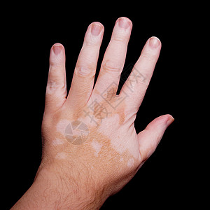 维蒂利哥白斑病男性色素沉着保健手指黑色素补丁颜料白色皮肤科图片