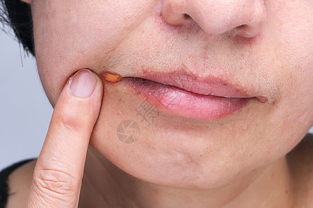 疱疹性咽峡炎角天颈炎是嘴唇经常发炎的一种方式药品女士女性疙瘩刺激香脂伤口口服水疱保健背景
