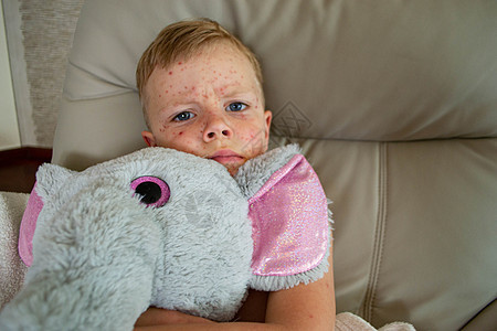 自然接种疫苗 传染性疾病条件疼痛孩子痘痘生活方式病人麻疹发烧疾病身体图片