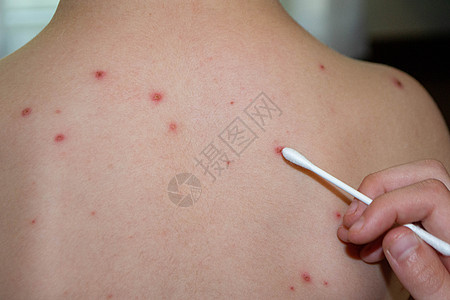 自然接种疫苗 传染性疾病症状病株女婴男婴病人身体发烧药品传染病皮肤图片