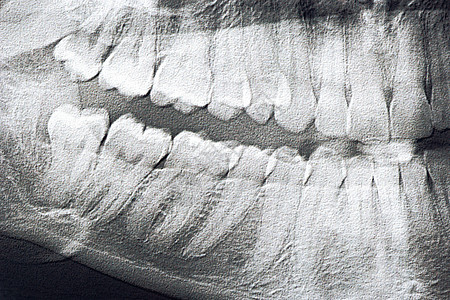 X光牙齿图片