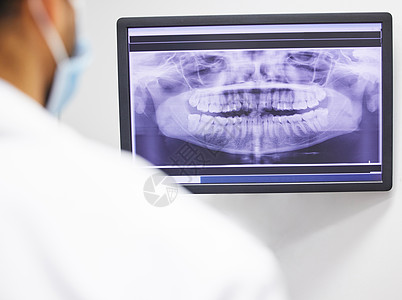 牙医分析病人牙齿X光片的牙印 他需要做抽取手术图片