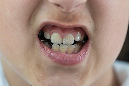 成人长牙出现在婴儿牙前 鲨鱼牙 小女孩的张嘴 牙医咨询 问题 掌声 请看医生病人女孩牛奶孩子们微笑嘴唇器具健康手指牙齿图片