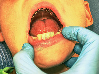 带固定牙套的嘴巴 口腔正畸方法塑料治愈诊断乳牙牙科手套手术咀嚼固定器男生图片